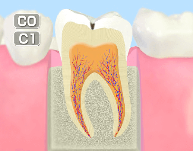 初期のむし歯(C1)