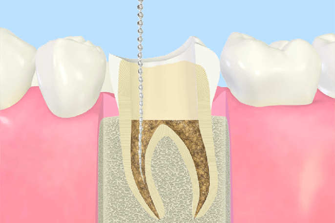 歯の根の治療
